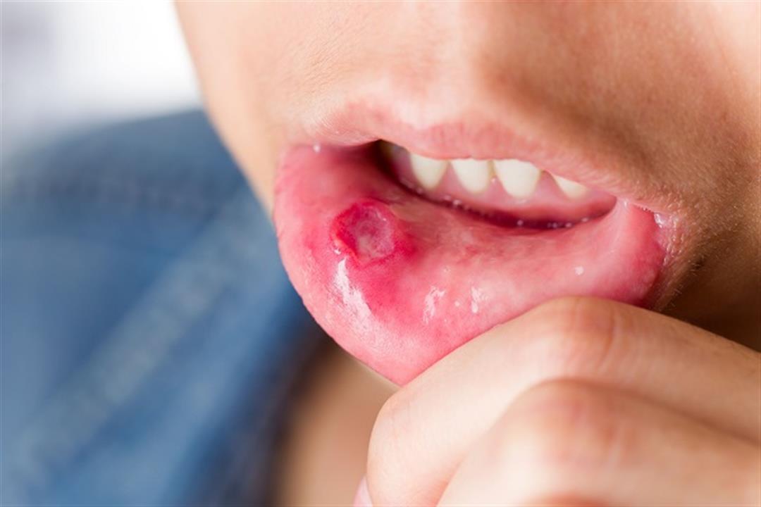 5 أسباب لتورم سقف الفم.. إليك طرق العلاج