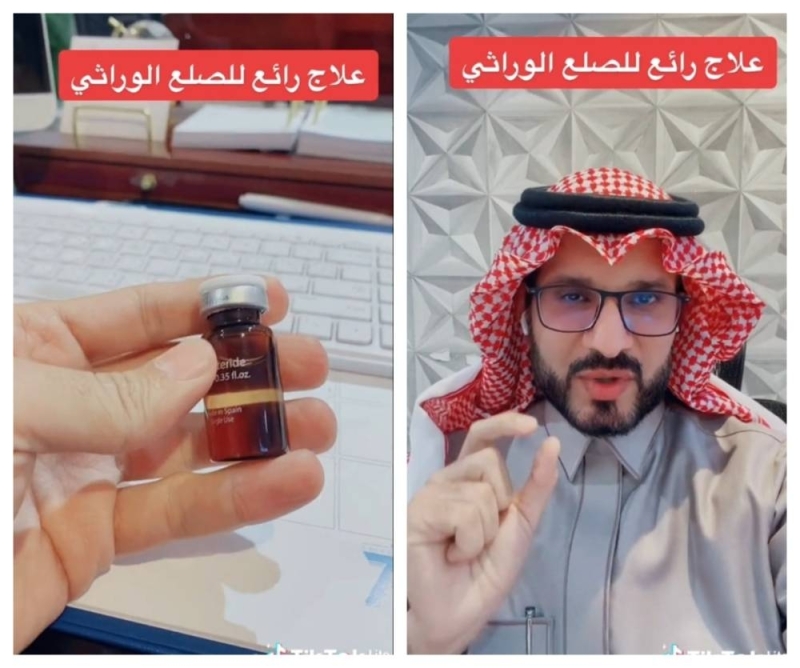 طبيب سعودي يكشف أحدث علاج متوفر ومرخص في المملكة لعلاج الصلع الوراثي للرجال والنساء (فيديو)