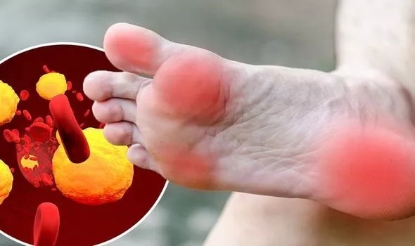 إذا لاحظت هذه العلامة على قدميك عند رفعها فهي دليل على ارتفاع مستويات الكوليسترول الضار بشكل خطير.. اذهب الى الطبيب فوراً؟